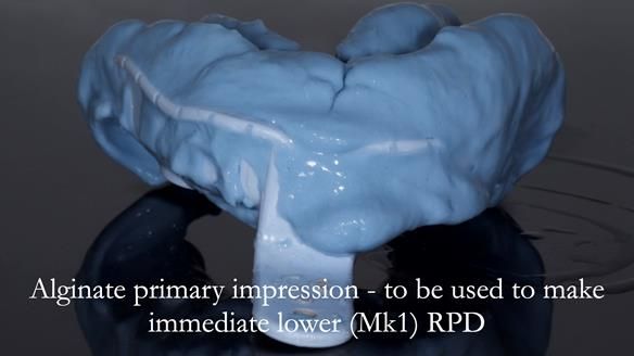 Newsletter 54 case presentation upper complete denture and lower Scandinavian designed hygienic partial denture for David