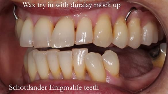 Newsletter 56 showing the making and fitting of a bilateral free end saddle upper removable partial denture (RPD) for patient with pemphigus