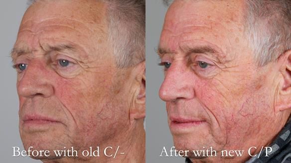 Newsletter 54 case presentation upper complete denture and lower Scandinavian designed hygienic partial denture for David