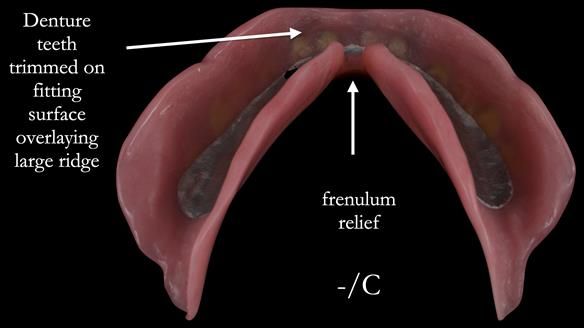 Newsletter 53 showing the making and fitting of ultra life-like dentures for Valena