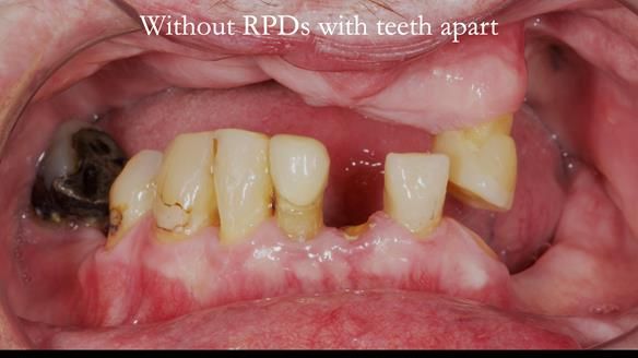 Newsletter 55 Provision of metal based partial dentures for Zephyrine with a repaired cleft lip and palate