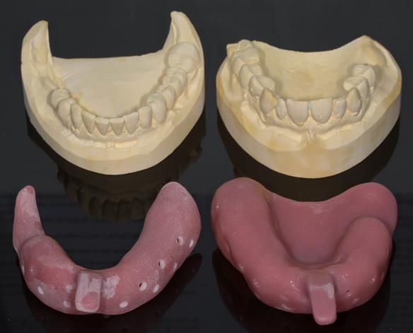 Figure 15 Custom trays for the definitive impression for Mk 1 dentures