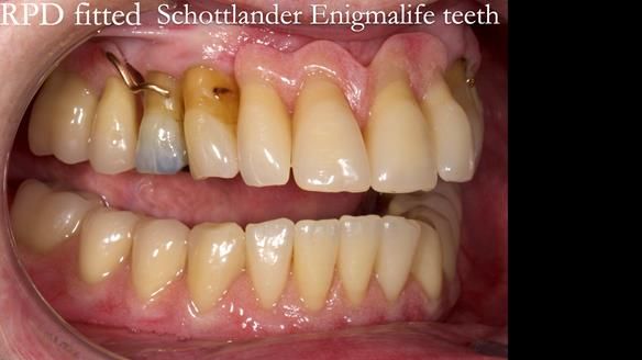 Finlay's Newsletter 59 Ultra hard partial dentures made for Gill