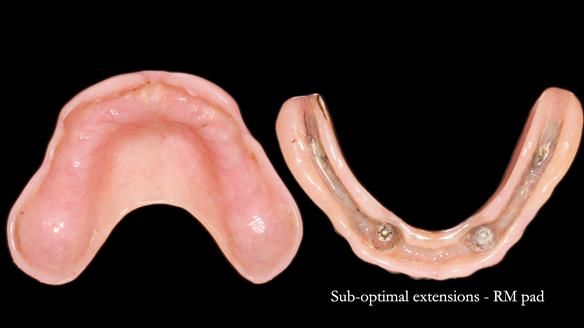 Newsletter 78: What do Clark Gable and a Locator® overdenture have in common?