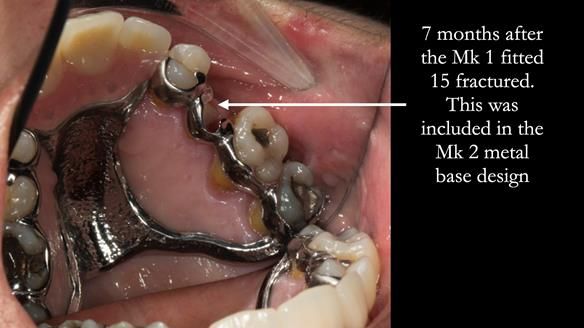 Finlay's Newsletter 63 Case study provision of metal based Scandinavian RPD - functional 10 years on