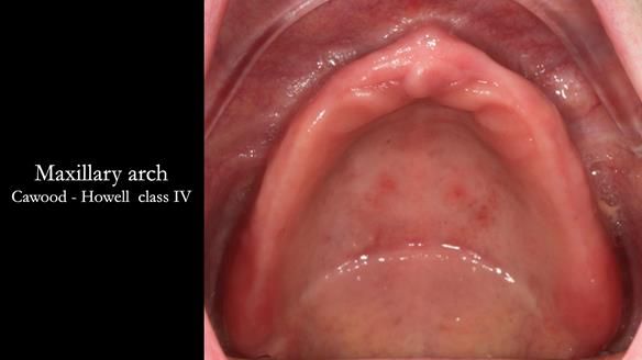 Newsletter 75: Marion’s case - Step-by-step complete denture workflow