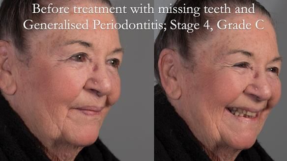 Finlay's Case Study Newsletter 40 - Immediate Mk 1 RPD to Definitive Mk 2 RPD - full protocol