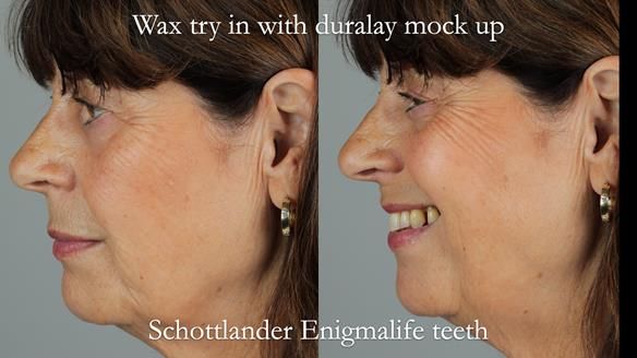 Newsletter 56 showing the making and fitting of a bilateral free end saddle upper removable partial denture (RPD) for patient with pemphigus