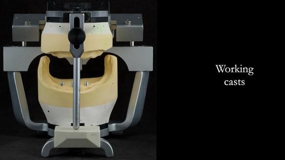 Working casts - class III skeletal relationship