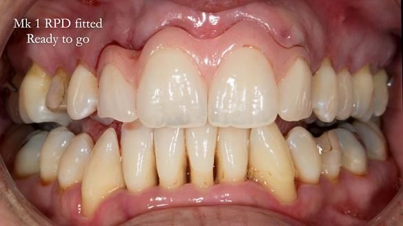 Finlay's Newsletter 63 Case study provision of metal based Scandinavian RPD - functional 10 years on
