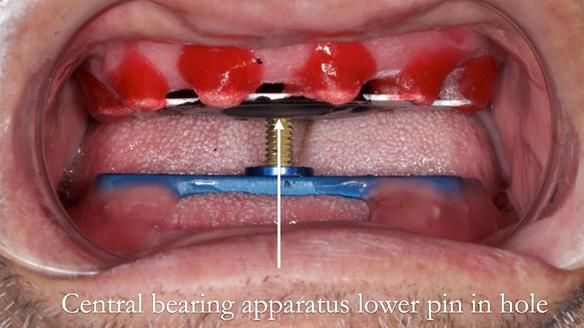 Managing poor implant positioning with complete dentures and Locator attachments - full protocol Newsletter 41
