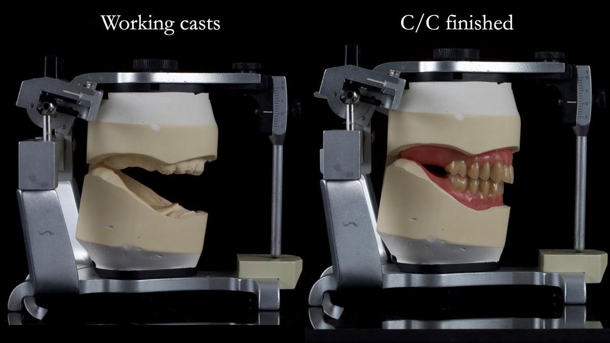 Fin’s Newsletter 88 — Complete dentures - full protocol… he rearranged his own teeth!