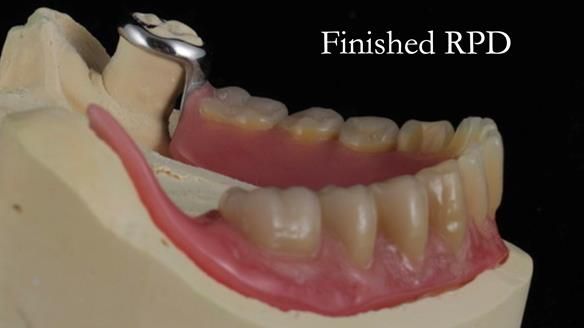 Finlay's Newsletter 59 Ultra hard partial dentures made for Gill