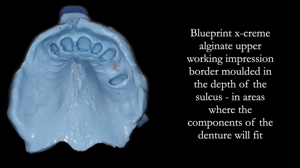 Newsletter 89 – Simon: A Challenging Kennedy Class II Division 1 Upper CoCr Partial Denture with a High Smile Line