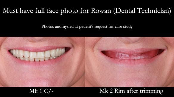 Newsletter 52 Managing Jo’s failing dentition with extractions and Mk 1/Mk 2 complete upper dentures and lower partial dentures FULL PROTOCOL