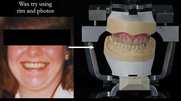 Finlay's Newsletter 58 Gasket upper partial denture for Zoe