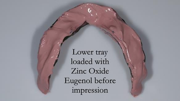 Managing poor implant positioning with complete dentures and Locator attachments - full protocol Newsletter 41
