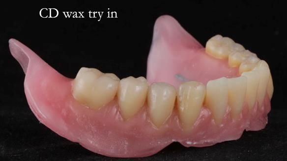 Finlay's Newsletter 62 provision of extractions and metal based complete dentures for Rafique