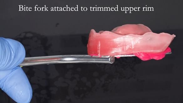 Newsletter 52 Managing Jo’s failing dentition with extractions and Mk 1/Mk 2 complete upper dentures and lower partial dentures FULL PROTOCOL