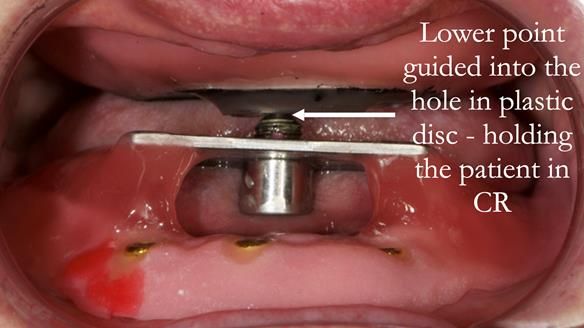 The central bearing apparatus is fixed together with Futar D bite registration material - locking the jaw position to centric relation