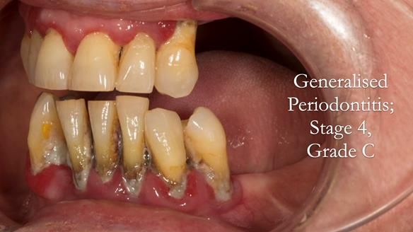 Finlay's Case Study Newsletter 40 - Immediate Mk 1 RPD to Definitive Mk 2 RPD - full protocol