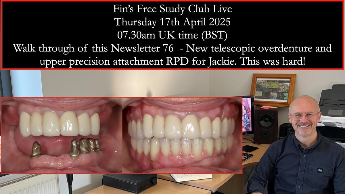Join me live on Zoom – Thursday 17 April 2025 at 7:30am (UK time) I’ll be sharing a full step-by-step walkthrough of Jackie’s telescopic overdenture and precision attachment RPD – including videos, clinical tips, and the challenges we faced (Rowan hated i