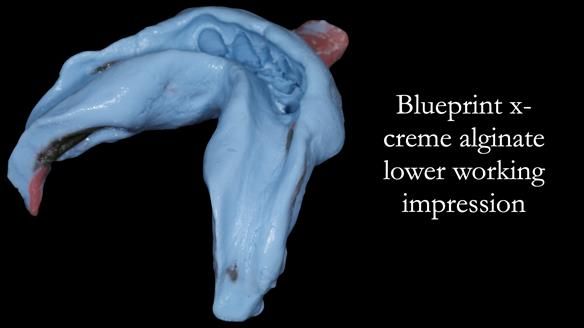 Newsletter 52 Managing Jo’s failing dentition with extractions and Mk 1/Mk 2 complete upper dentures and lower partial dentures FULL PROTOCOL