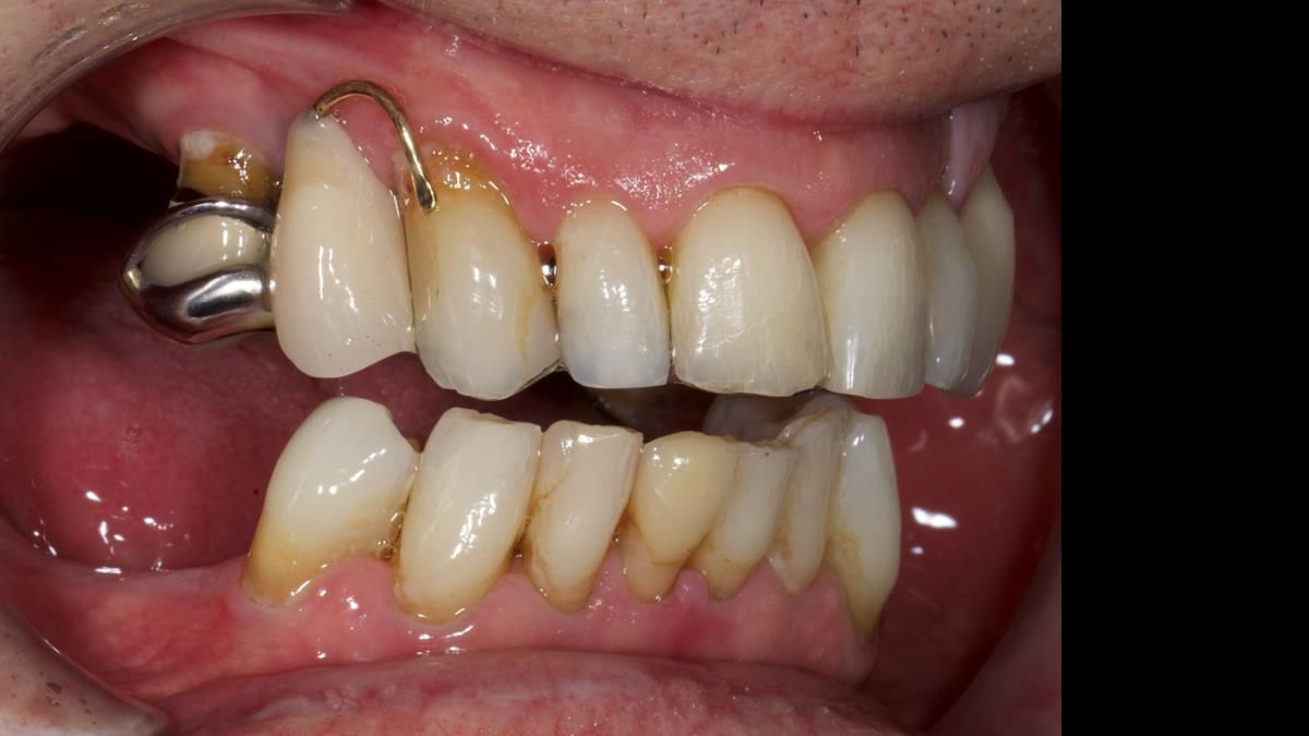 Newsletter 89 – Simon: A Challenging Kennedy Class II Division 1 Upper CoCr Partial Denture with a High Smile Line