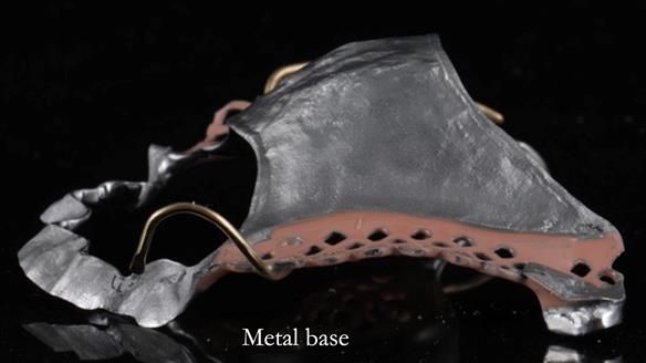 Finlay's Newsletter 60 Sylvia's upper Kennedy Class 2 Mod 1 metal based upper RPD