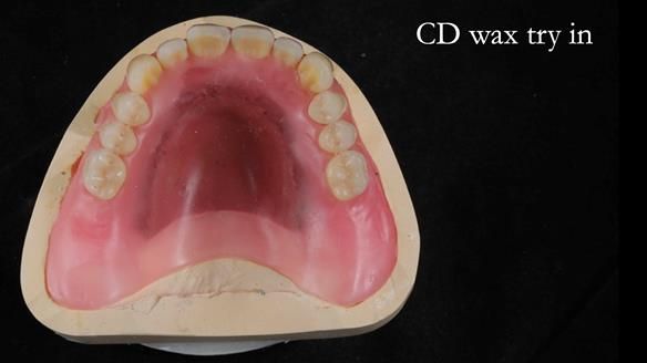 Finlay's Newsletter 62 provision of extractions and metal based complete dentures for Rafique
