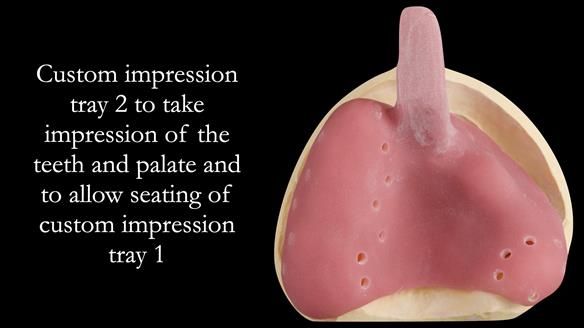 Upper metal base partial denture/occlusal stabilisation splint/obturator - full protocol