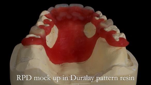 Newsletter 81 - Pam’s Story — how a partial denture changed her life (+ live walkthrough this Thursday)