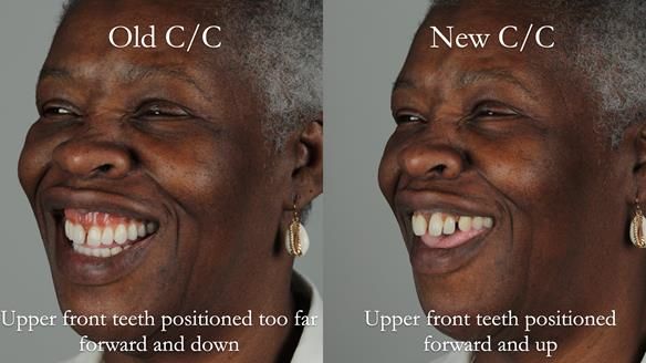 Newsletter 53 showing the making and fitting of ultra life-like dentures for Valena