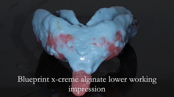 Newsletter 54 case presentation upper complete denture and lower Scandinavian designed hygienic partial denture for David