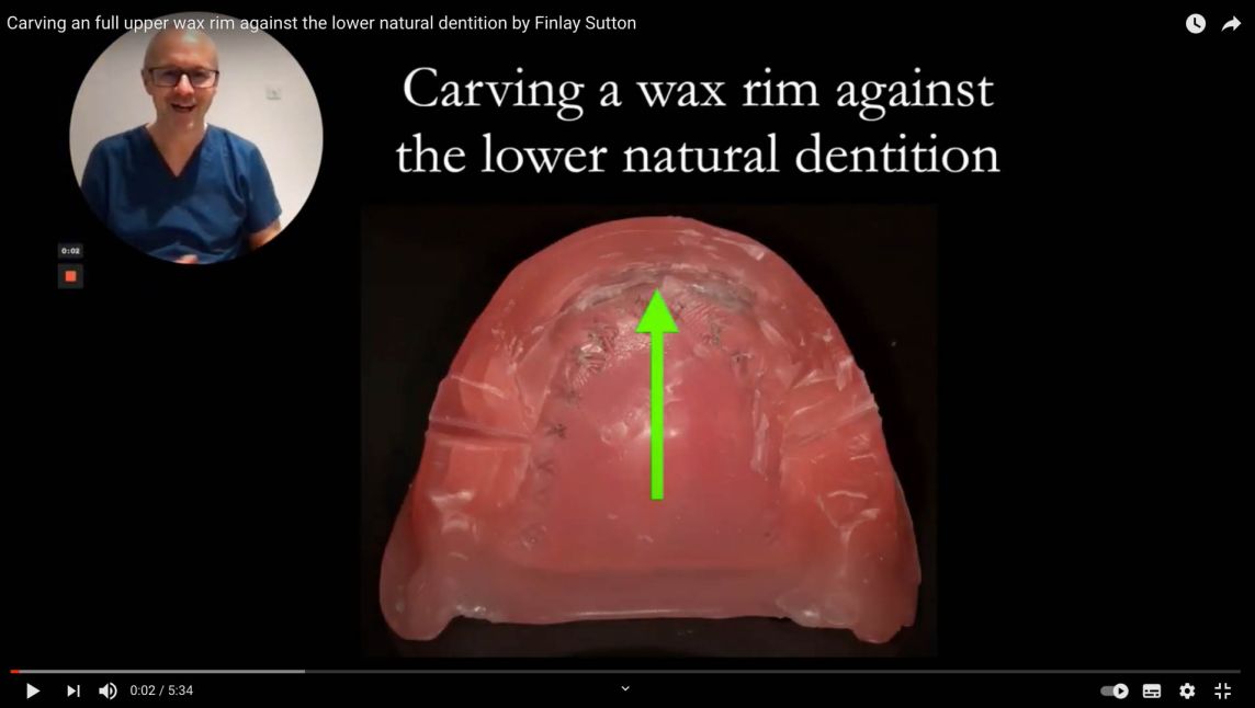 Carving a full upper wax rim against the lower natural dentition