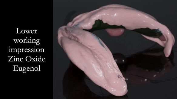 Newsletter 75: Marion’s case - Step-by-step complete denture workflow