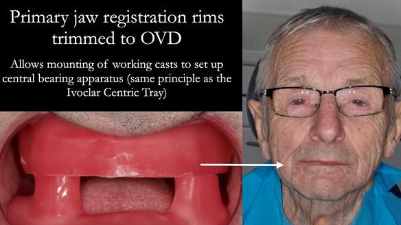 Newsletter 80 - Gordon’s dentures: the one case in 1,000 where my technique failed