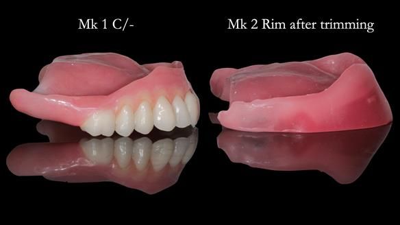 Newsletter 52 Managing Jo’s failing dentition with extractions and Mk 1/Mk 2 complete upper dentures and lower partial dentures FULL PROTOCOL