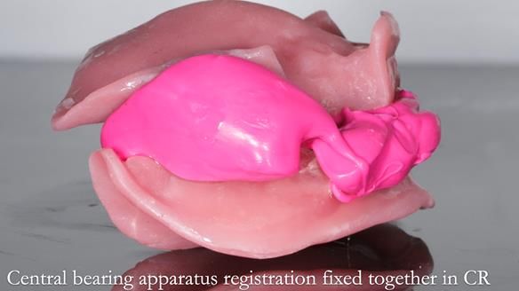 Finlay's Newsletter 59 Ultra hard partial dentures made for Gill