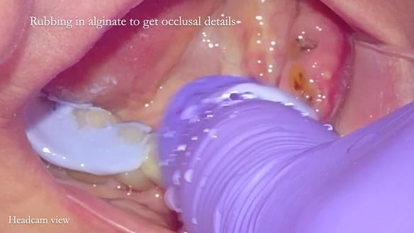 Newsletter 82 Mary - A complete upper and a one-tooth gasket denture