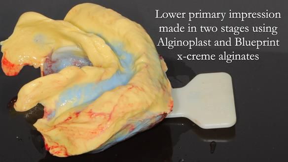 Finlay's Newsletter 62 provision of extractions and metal based complete dentures for Rafique