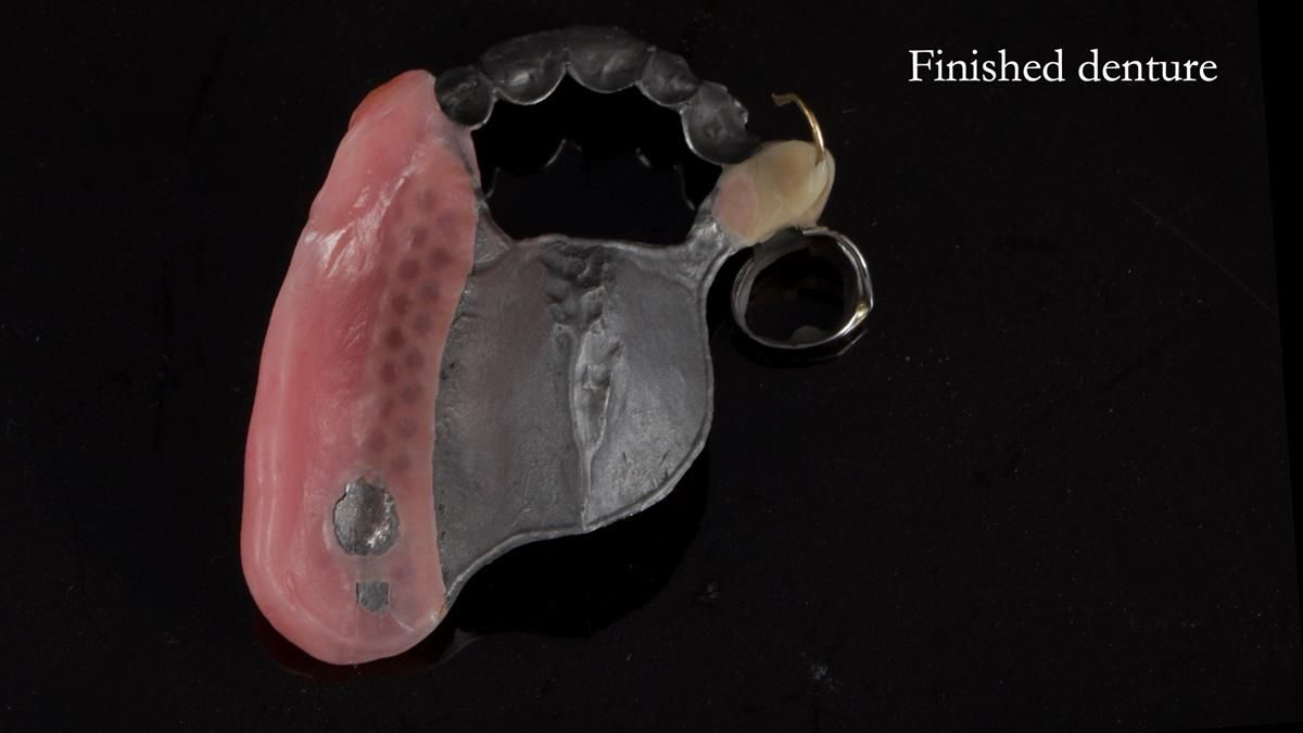 Newsletter 89 – Simon: A Challenging Kennedy Class II Division 1 Upper CoCr Partial Denture with a High Smile Line