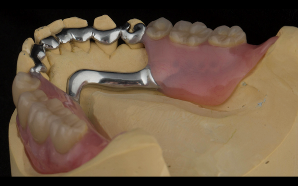 Figure 110 Mk 2 mandibular metal based denture showing open Scandinavian hygienic design.
