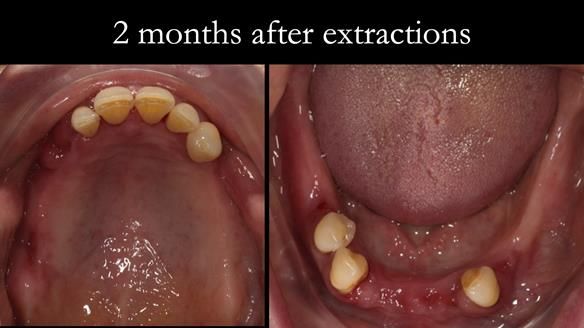 Finlay's Case Study Newsletter 40 - Immediate Mk 1 RPD to Definitive Mk 2 RPD - full protocol