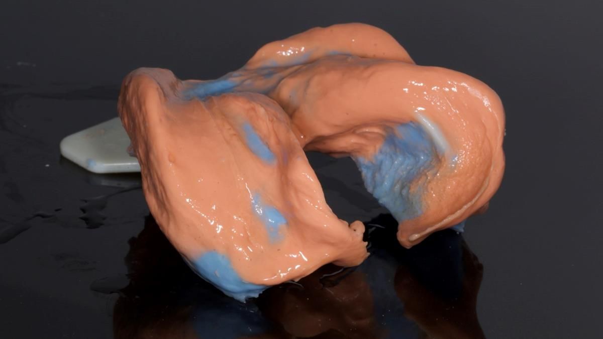 Fin’s Newsletter 88 — Complete dentures - full protocol… he rearranged his own teeth!