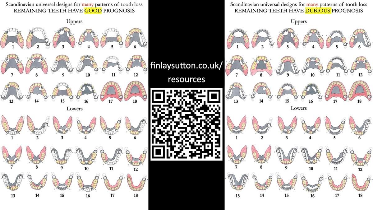 Newsletter 89 – Simon: A Challenging Kennedy Class II Division 1 Upper CoCr Partial Denture with a High Smile Line