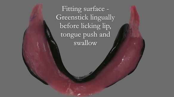 Finlay's Newsletter 62 provision of extractions and metal based complete dentures for Rafique