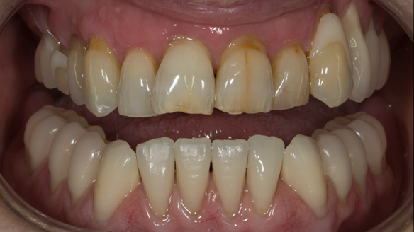 Figure 31 Finished denture mimicking the natural teeth. Schottlander Enigmalife denture teeth and Dental D clasps