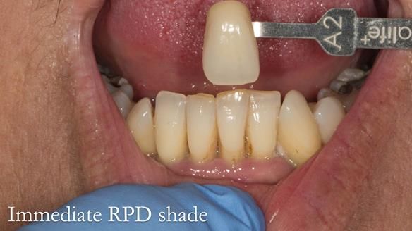 Finlay's Newsletter 63 Case study provision of metal based Scandinavian RPD - functional 10 years on