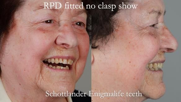 Finlay's Newsletter 60 Sylvia's upper Kennedy Class 2 Mod 1 metal based upper RPD